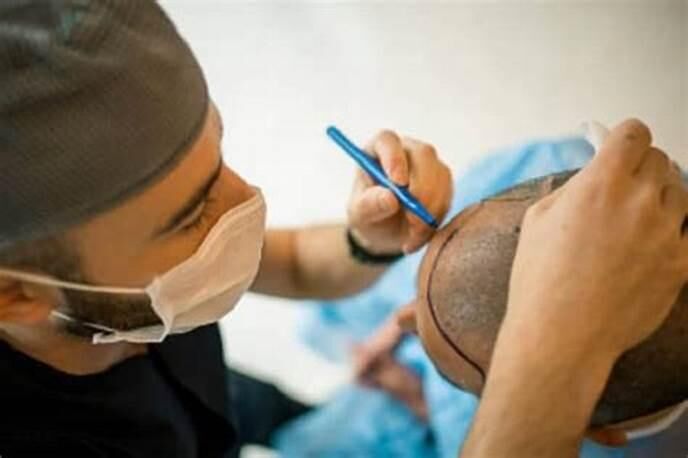 Why Get a Hair Transplant & How to Choose a Clinic in Fort Lauderdale